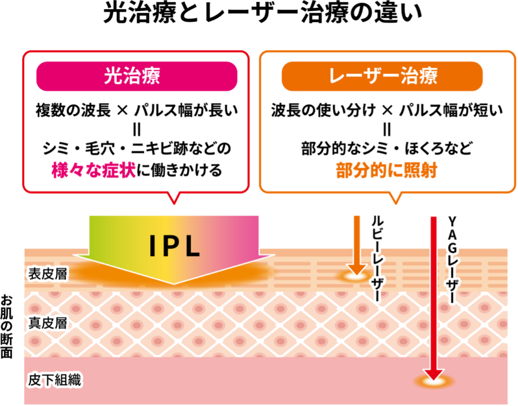 フォトトリートメント